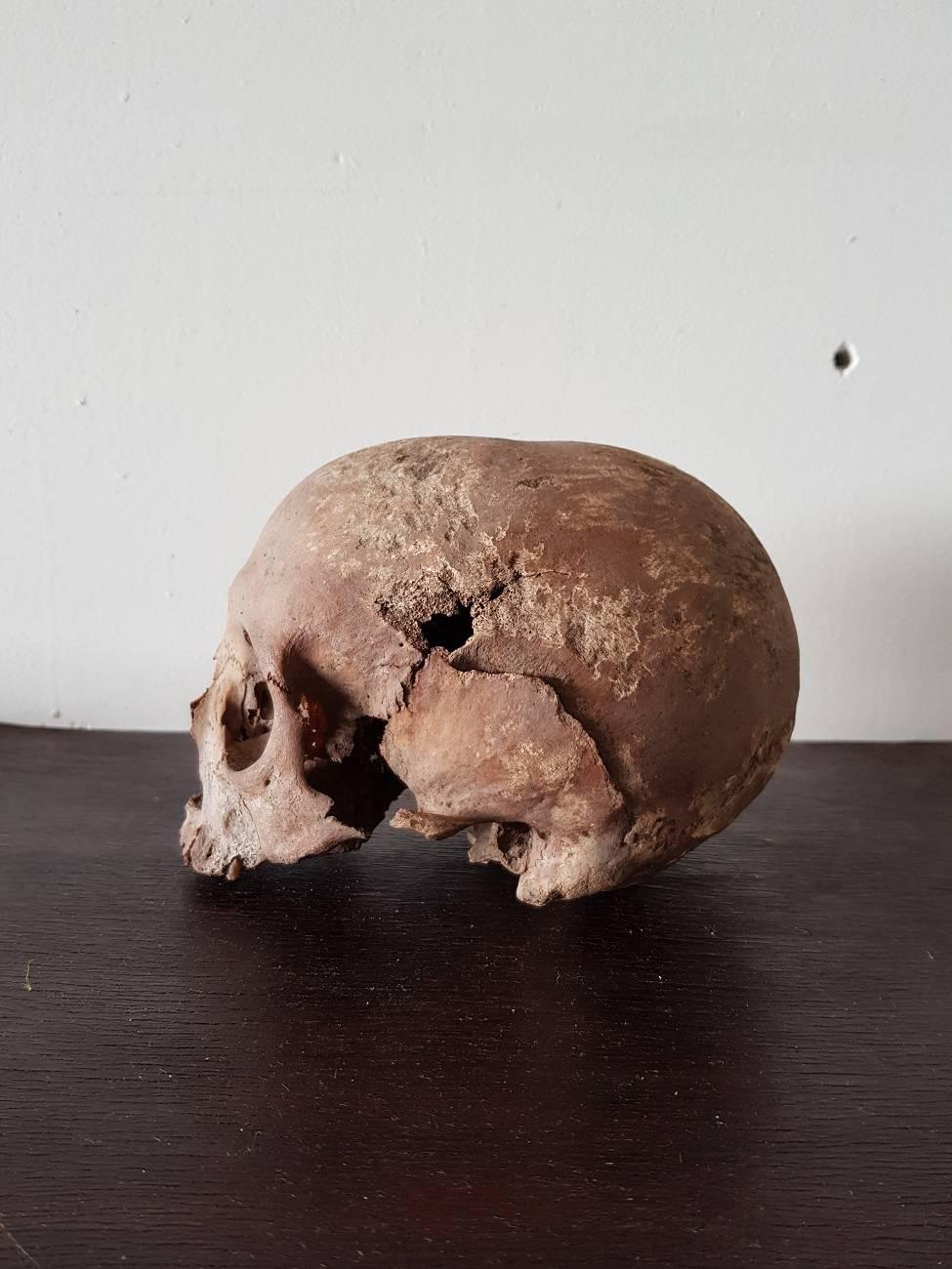 Original antique human skull from the 19th century with a skull trauma to the left side, it comes from a private collection and bought legally.

The measurements are,
Depth 18 cm/ 7 inch.
Width 14 cm/ 5.5 inch.
Height 13 cm/ 5.1 inch.
   