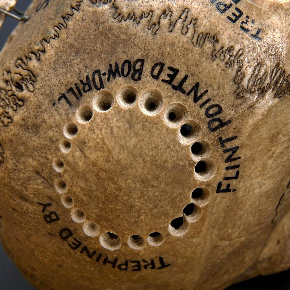 Early Victorian 19th Century English Surgeon's Brain Trepanning Tool Kit