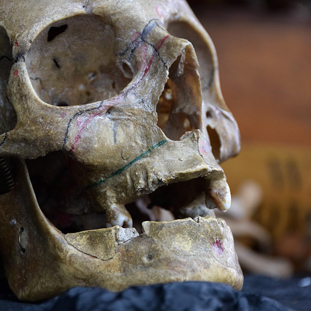 19th Century Half Human Medical Skelton 4