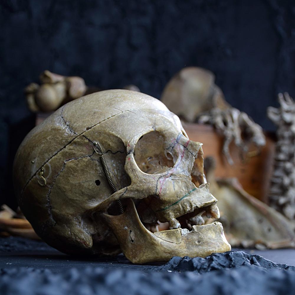 Early Victorian 19th Century Half Human Medical Skelton