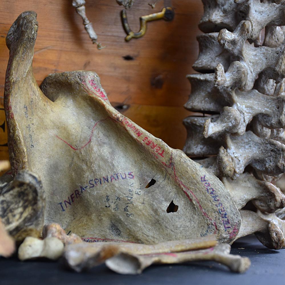 19th Century Half Human Medical Skelton In Distressed Condition In London, GB