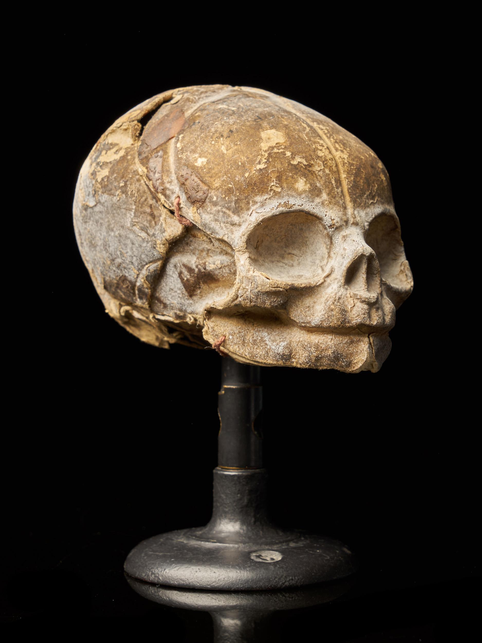foetal skull