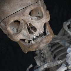 19th century surgical human skeleton example