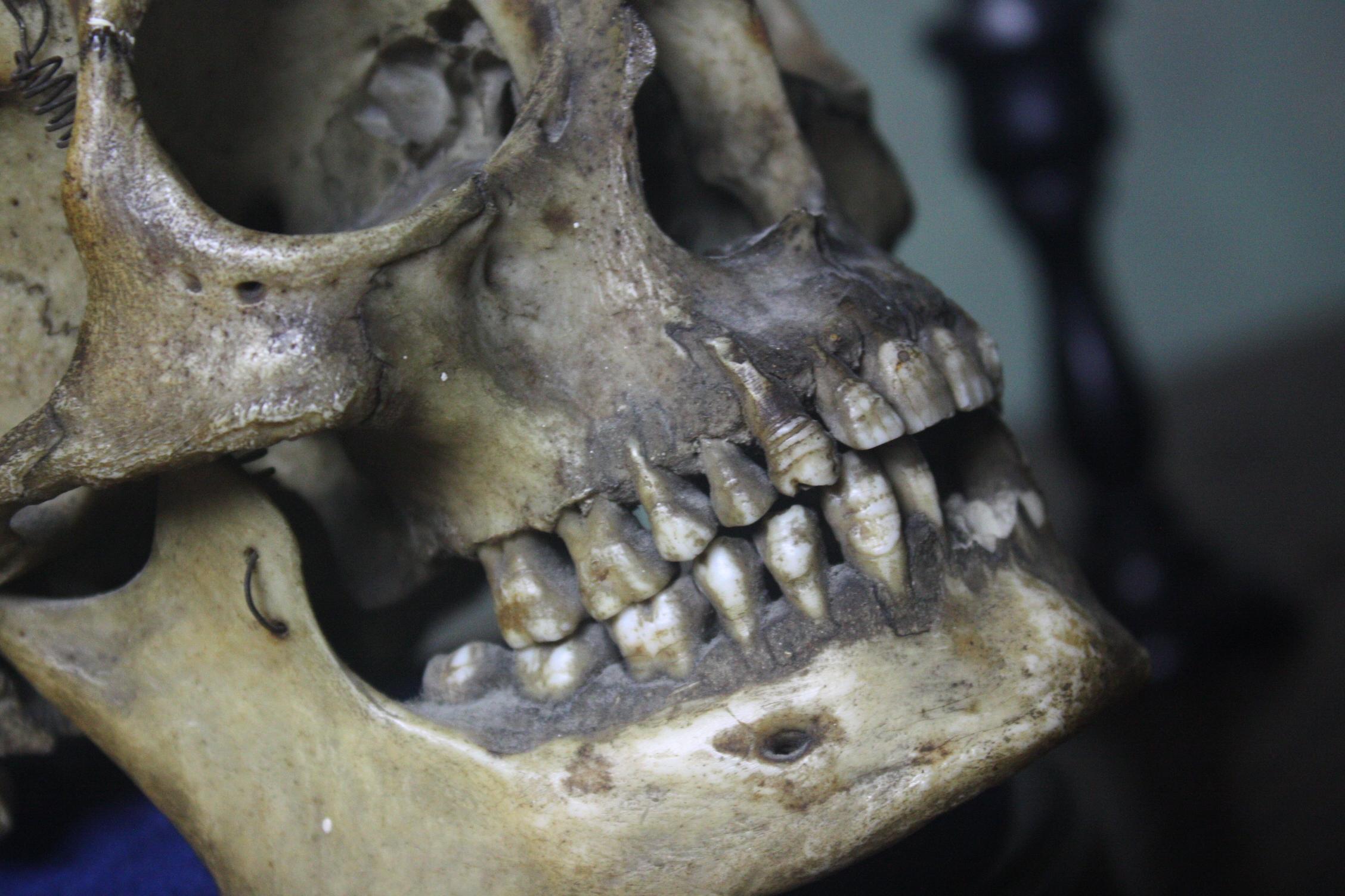 A wonderful tobacco jar, made from a human skull. The skull has had its cranium removed and a tin container inlaid within a turned bone handle has been applied to the cranium. A rhyme has been scrafittoed into the forehead reading as