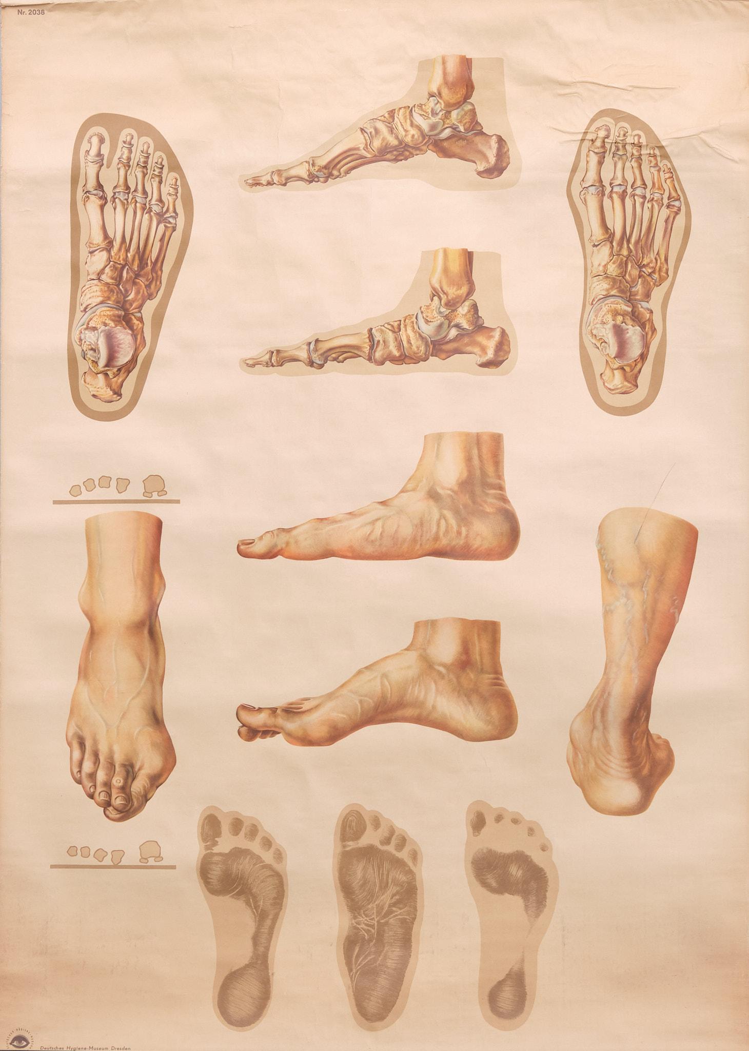 Allemand Un tableau mural médical vintage retravaillant illustrant « Orthopedics of Foot » des années 1930  en vente