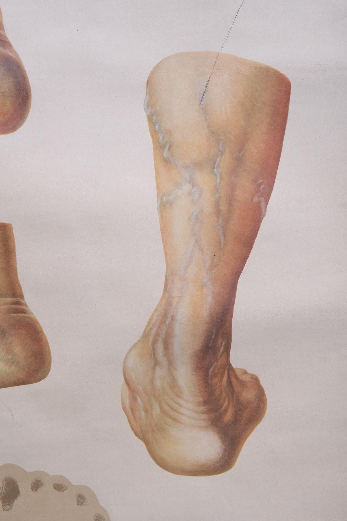 Lin Un tableau mural médical vintage retravaillant illustrant « Orthopedics of Foot » des années 1930  en vente