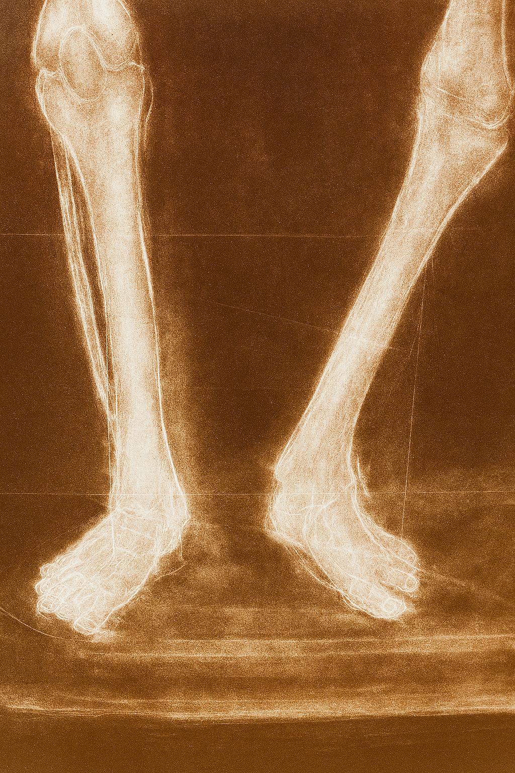 Alain Gerard Clement Silber Gelatine Fotogenes Bild Menschliches Skelett (Handgefertigt) im Angebot