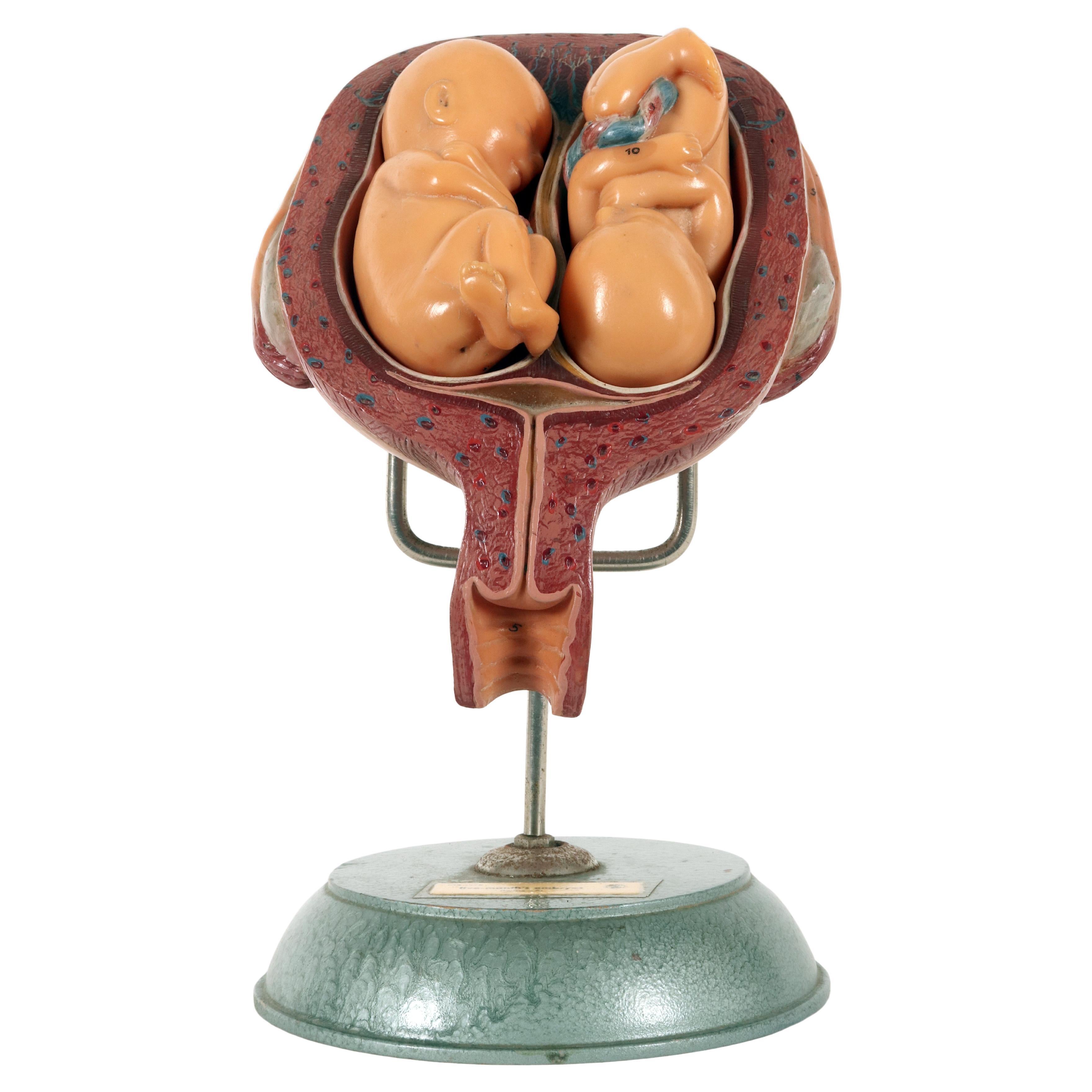 Anatomical teaching model, the prenatal twin fetus gestation. Somso Germany 1950