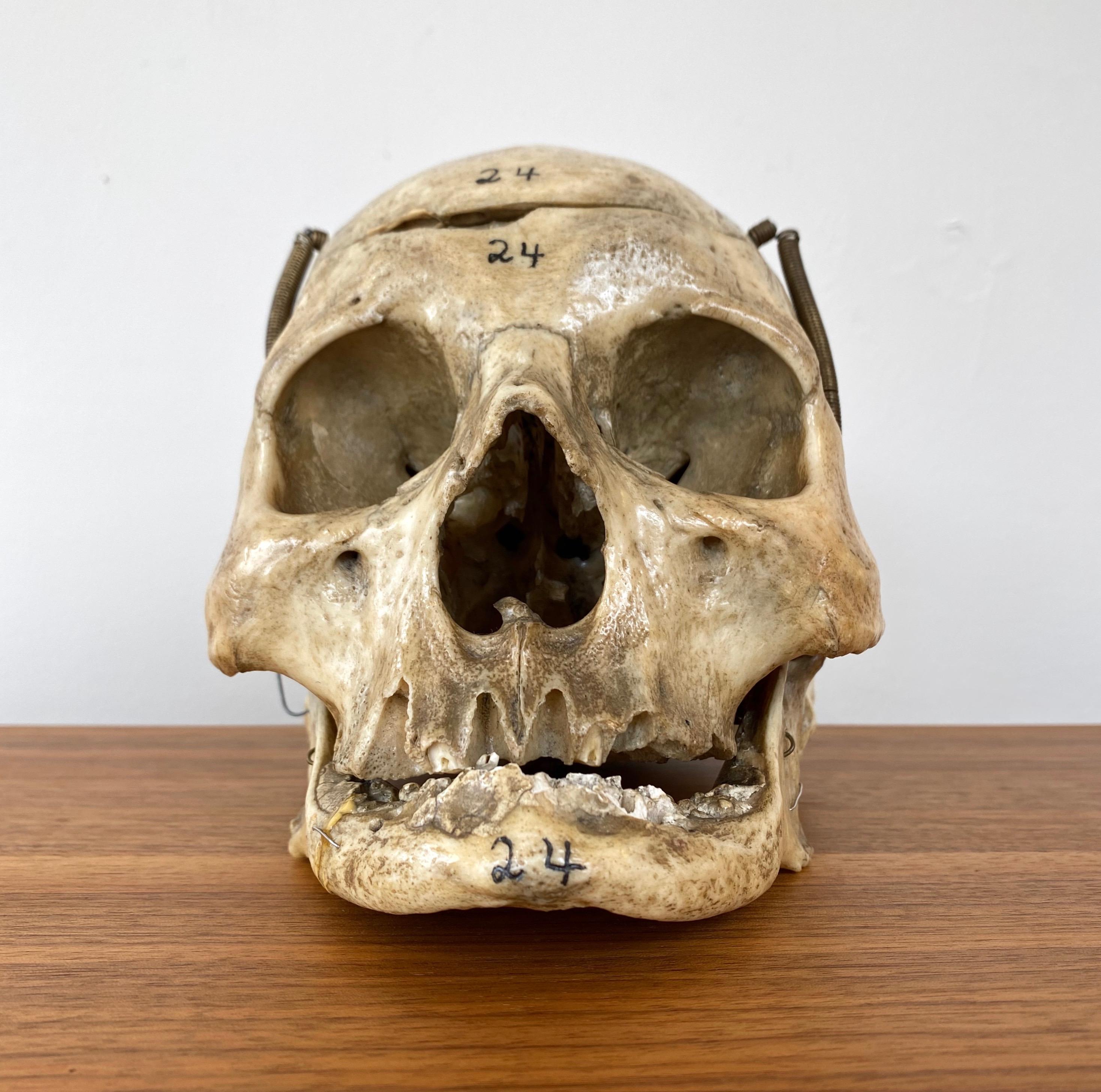 A very handsome antique articulated human skull that served as a medical teaching specimen beginning in about 1920.

Full of character, it features a cut calvarium secured to the mandible via pins and long springs, allowing for articulation of the