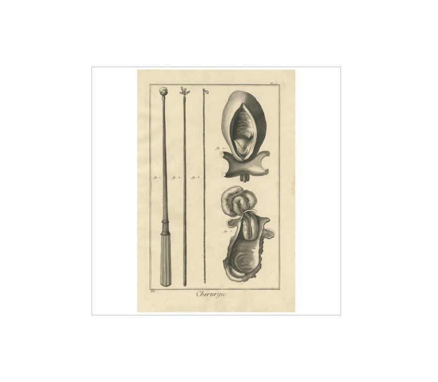 Plate V: 'Chirurgie'. (Surgery.) This plate shows medical instruments relating to surgery of the esophagus. This print originates from 'Encyclopédie (..)' by D. Diderot. Published circa 1760.