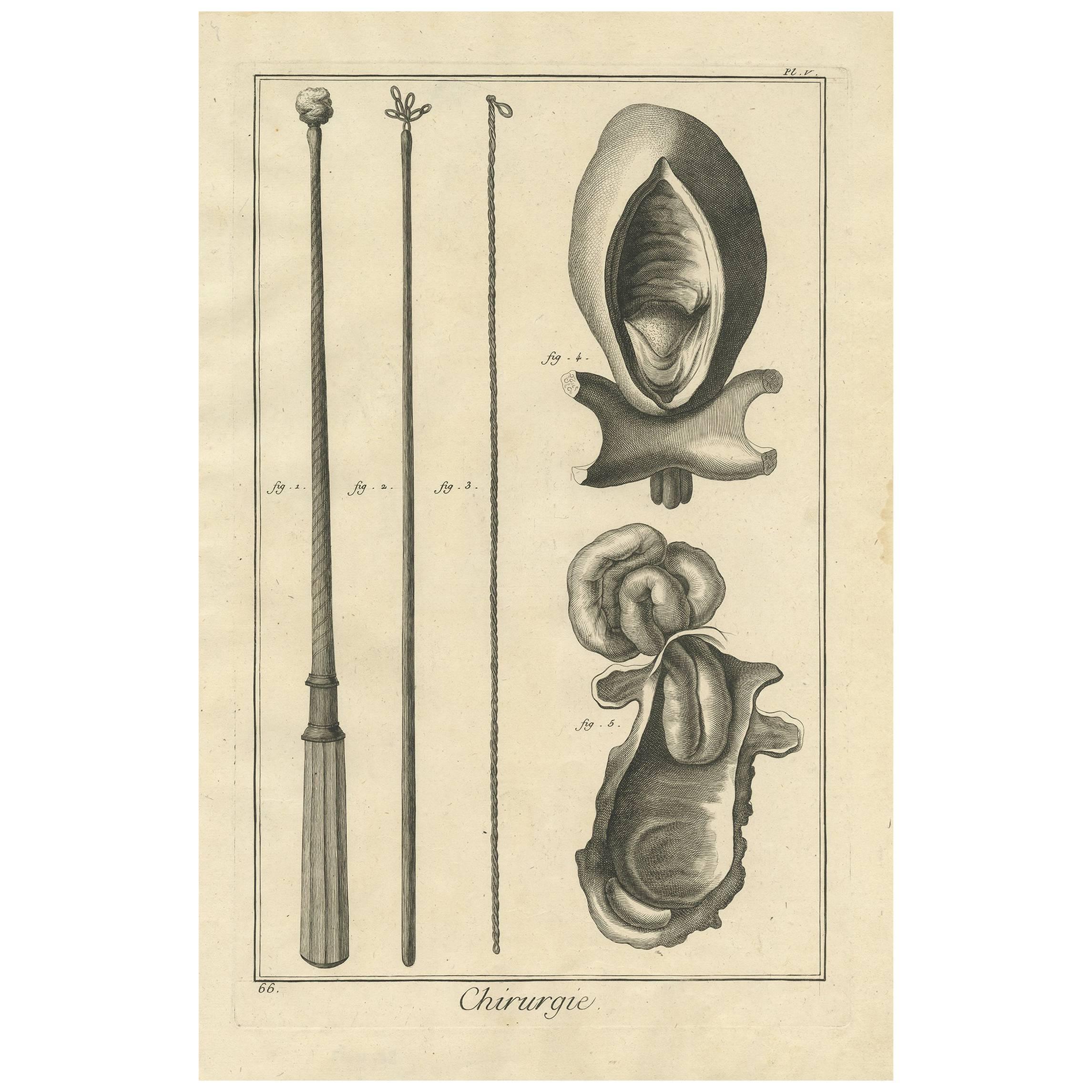 Antique Medical Print 'Pl. V' by D. Diderot, circa 1760 For Sale