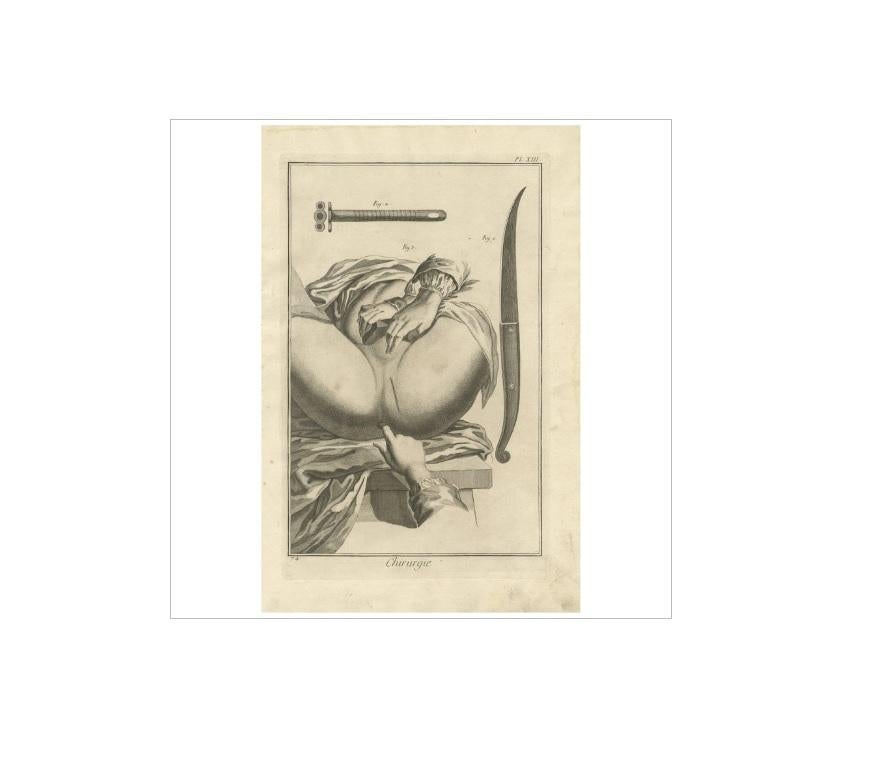 Plate XIII: 'Chirurgie'. (Surgery.) This plate shows a scalpel, flexible cannula and the perineum where the direction of the outer incision is marked. This print originates from 'Encyclopédie (..)' by D. Diderot. Published, circa 1760.