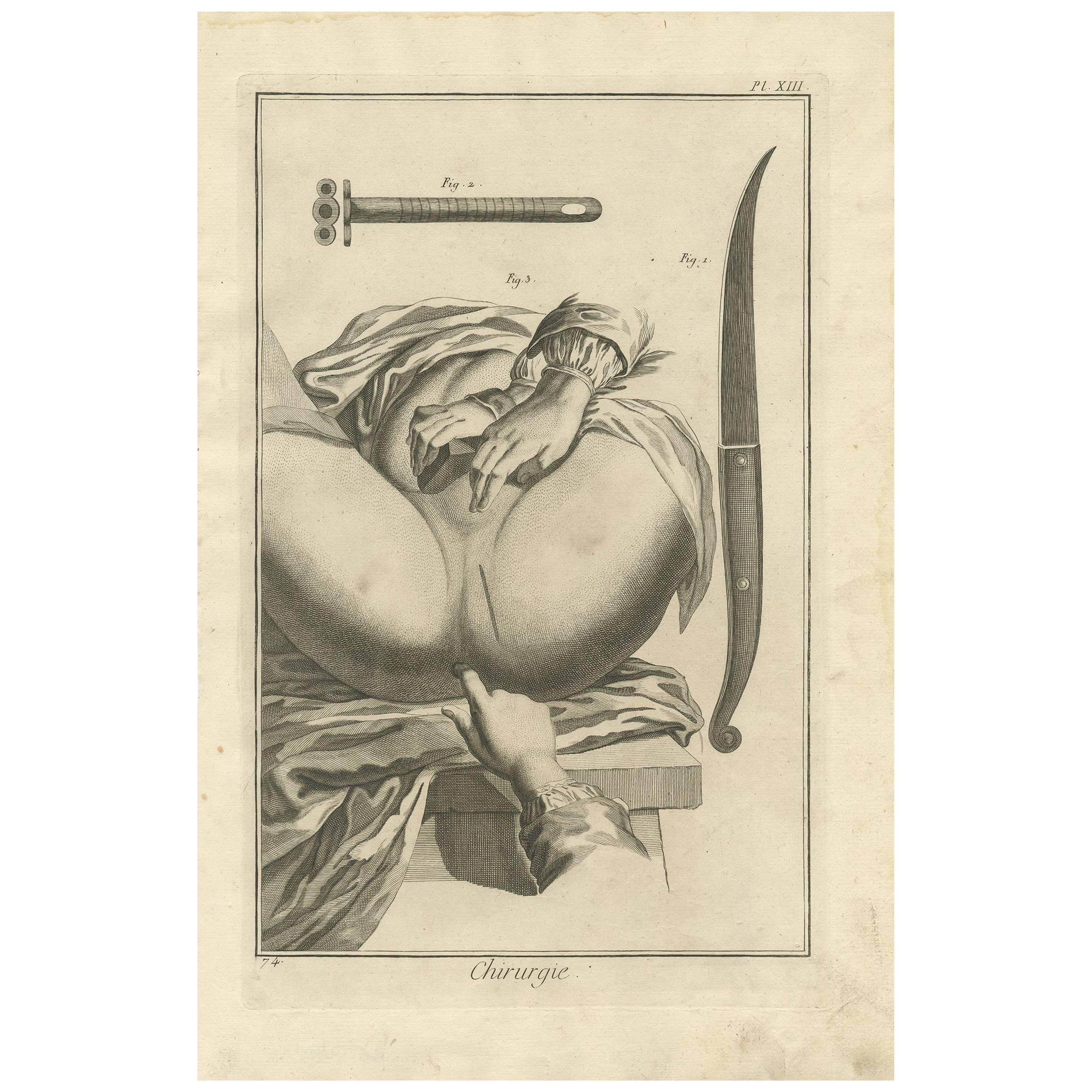 Antique Medical Print 'Pl. XIII' by D. Diderot, circa 1760