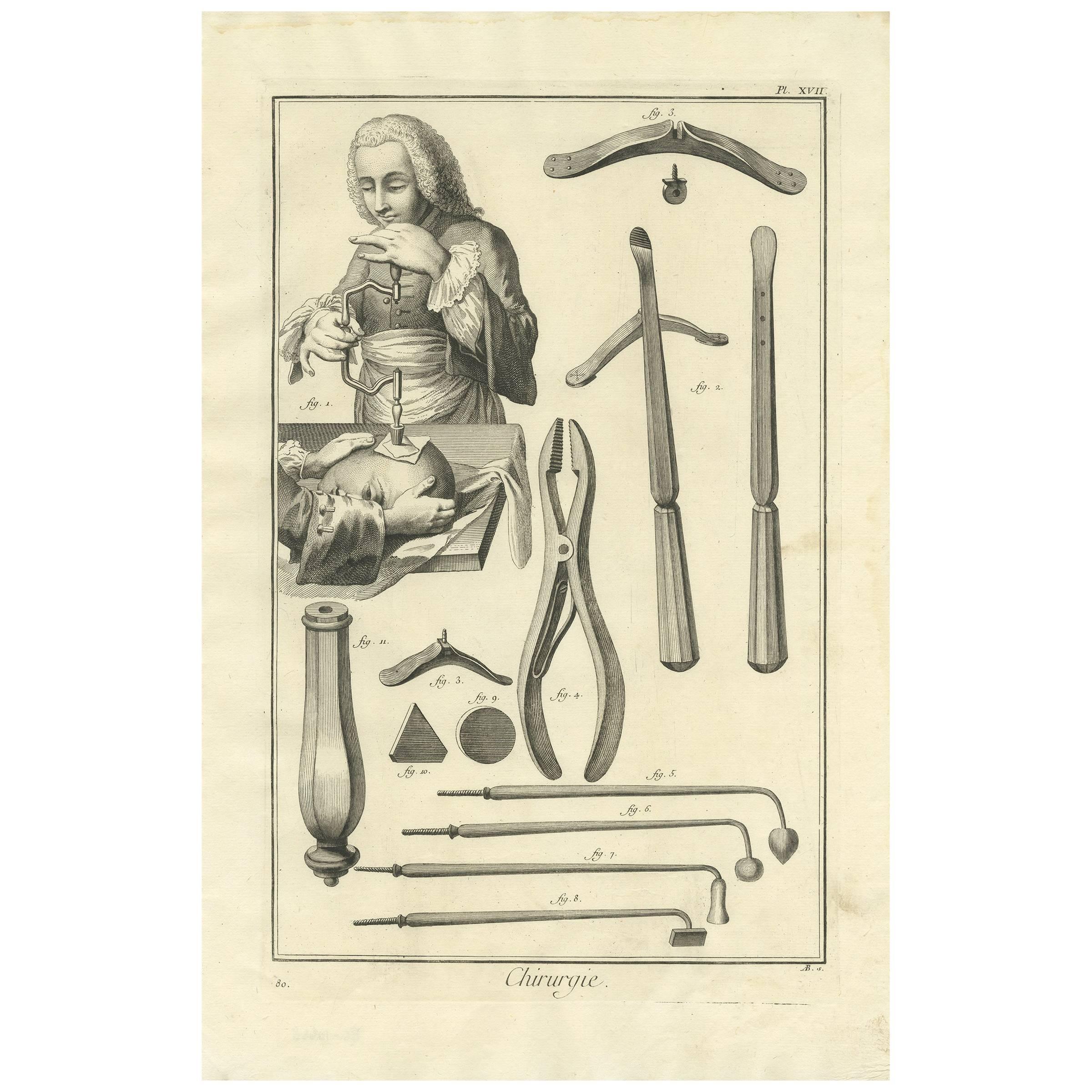 Impression médicale ancienne d'antiquités XVII' par D. Diderot, vers 1760 en vente