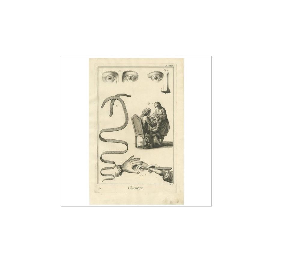Impression médicale ancienne 'Pl. XXIV' par D. A., vers 1760 Bon état - En vente à Langweer, NL