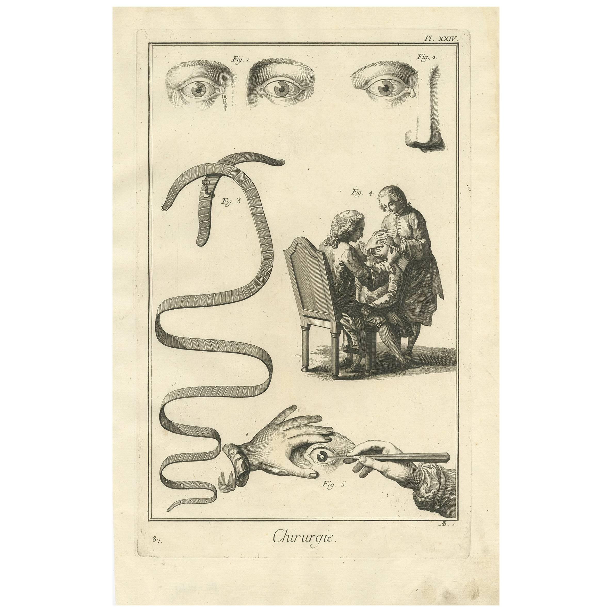 Antique Medical Print 'Pl. XXIV' by D. Diderot, circa 1760