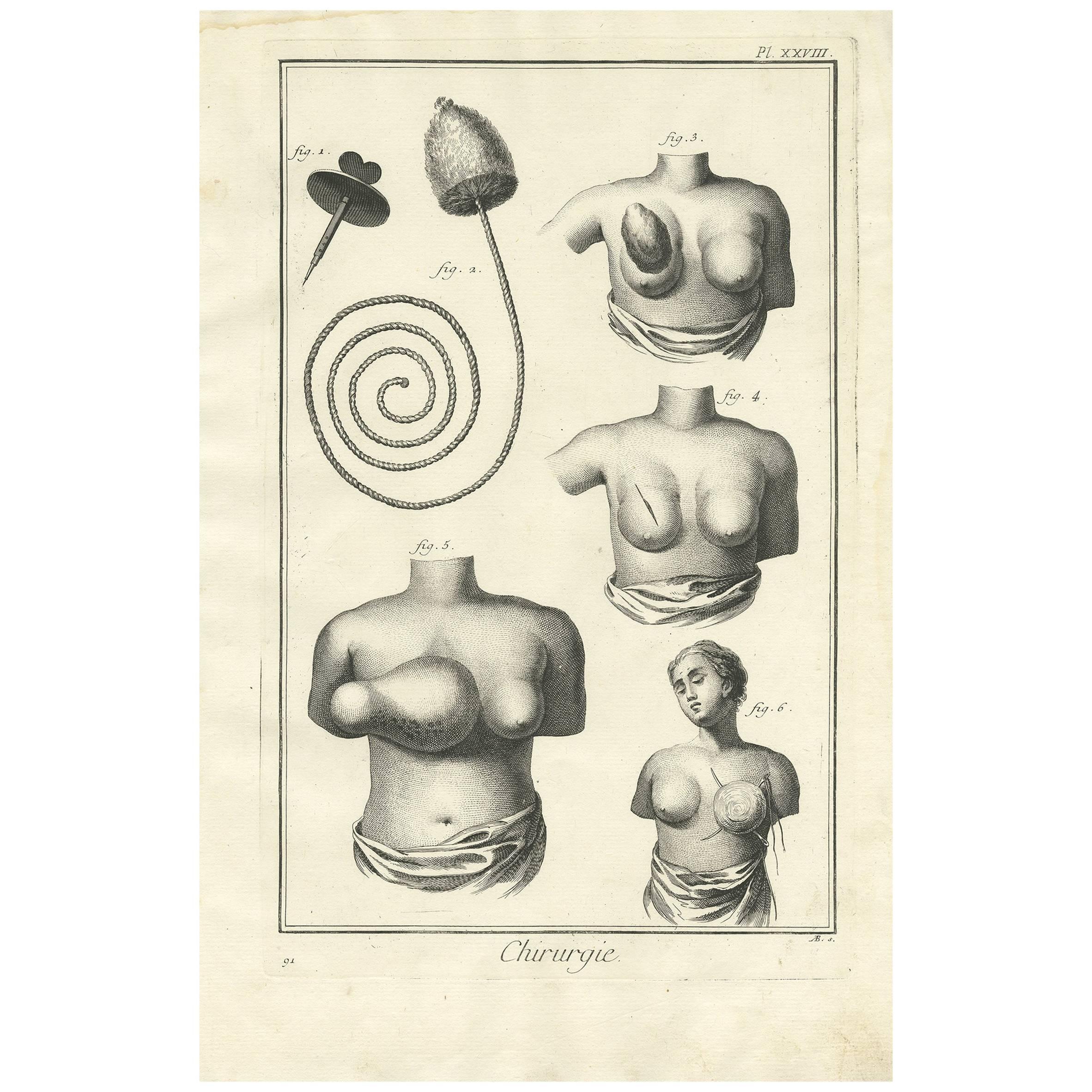 Impression médicale ancienne d'antiquités XXVIII' par D. Diderot, vers 1760 en vente