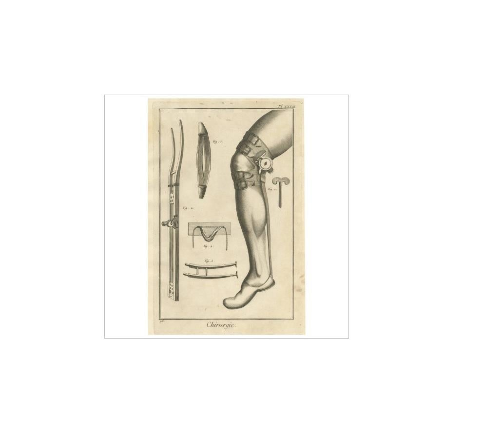 Plate XXXIII: 'Chirurgie'. (Surgery.) This plate shows medical instruments / devices for treating the achilles tendon. This print originates from 'Encyclopédie (..)' by D. Diderot. Published, circa 1760.