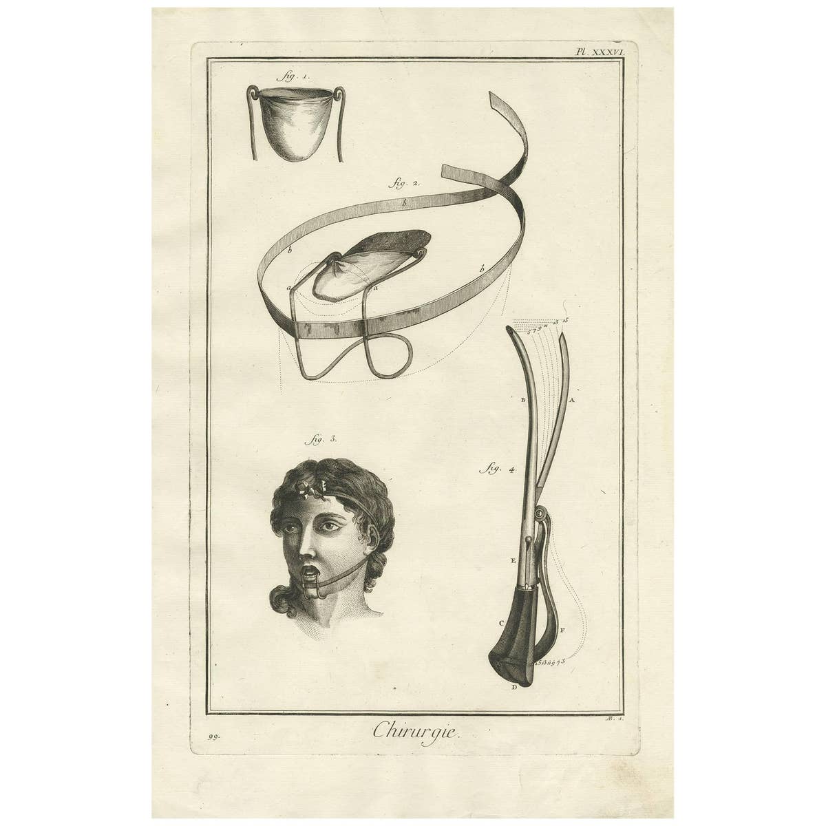 Antique Medical Print 'Pl. XXXVI' by D. Diderot, circa 1760
