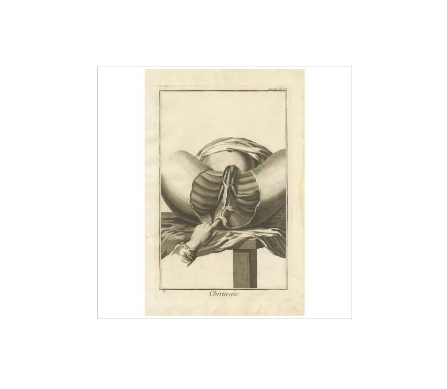 Plate XIII Seconde: 'Chirurgie'. (Surgery.) This plate shows the perineal muscles of a sixteen year old. This print originates from 'Encyclopédie (..)' by D. Diderot. Published circa 1760.