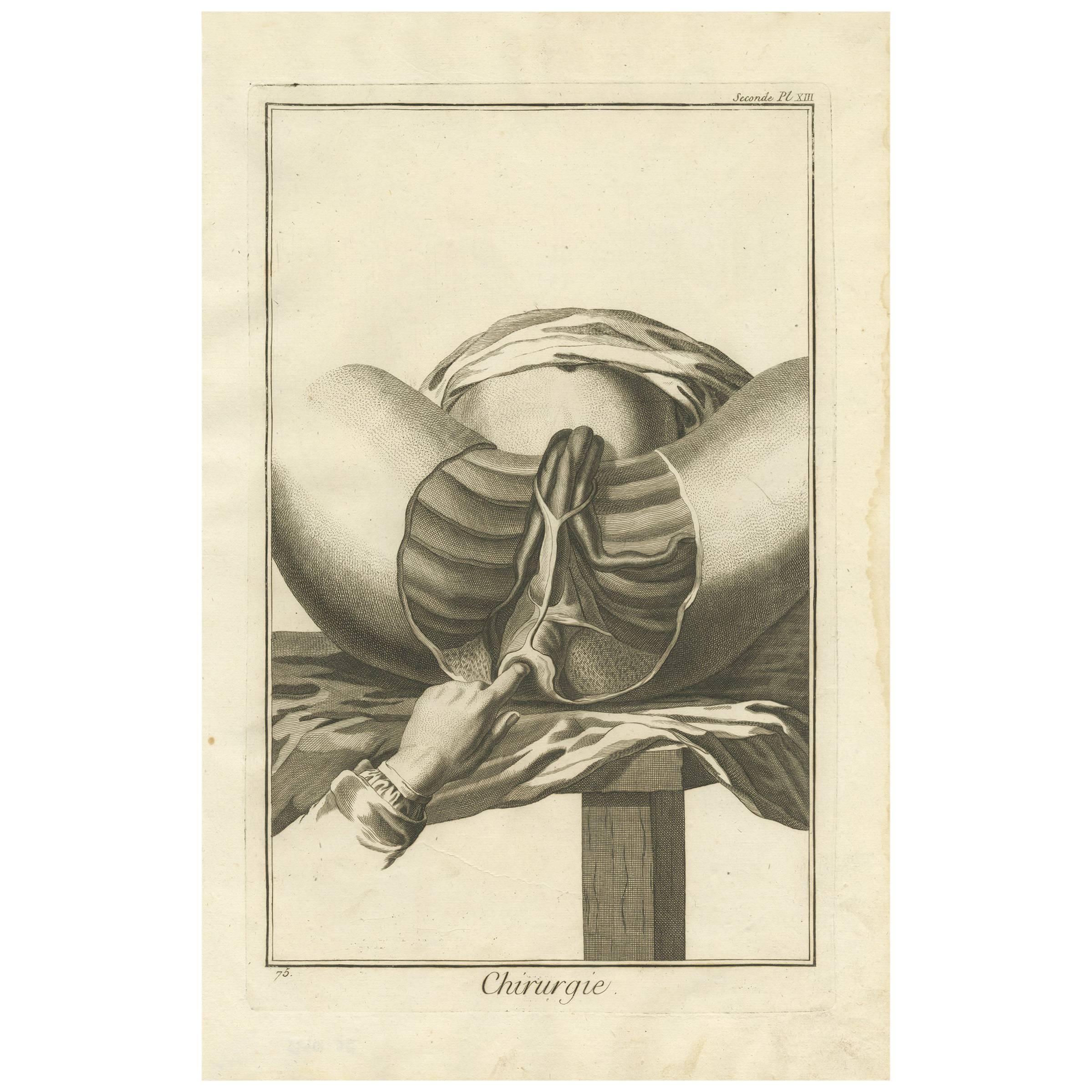 Antique Medical Print 'Seconde Pl. XIII' by D. Diderot, circa 1760 For Sale