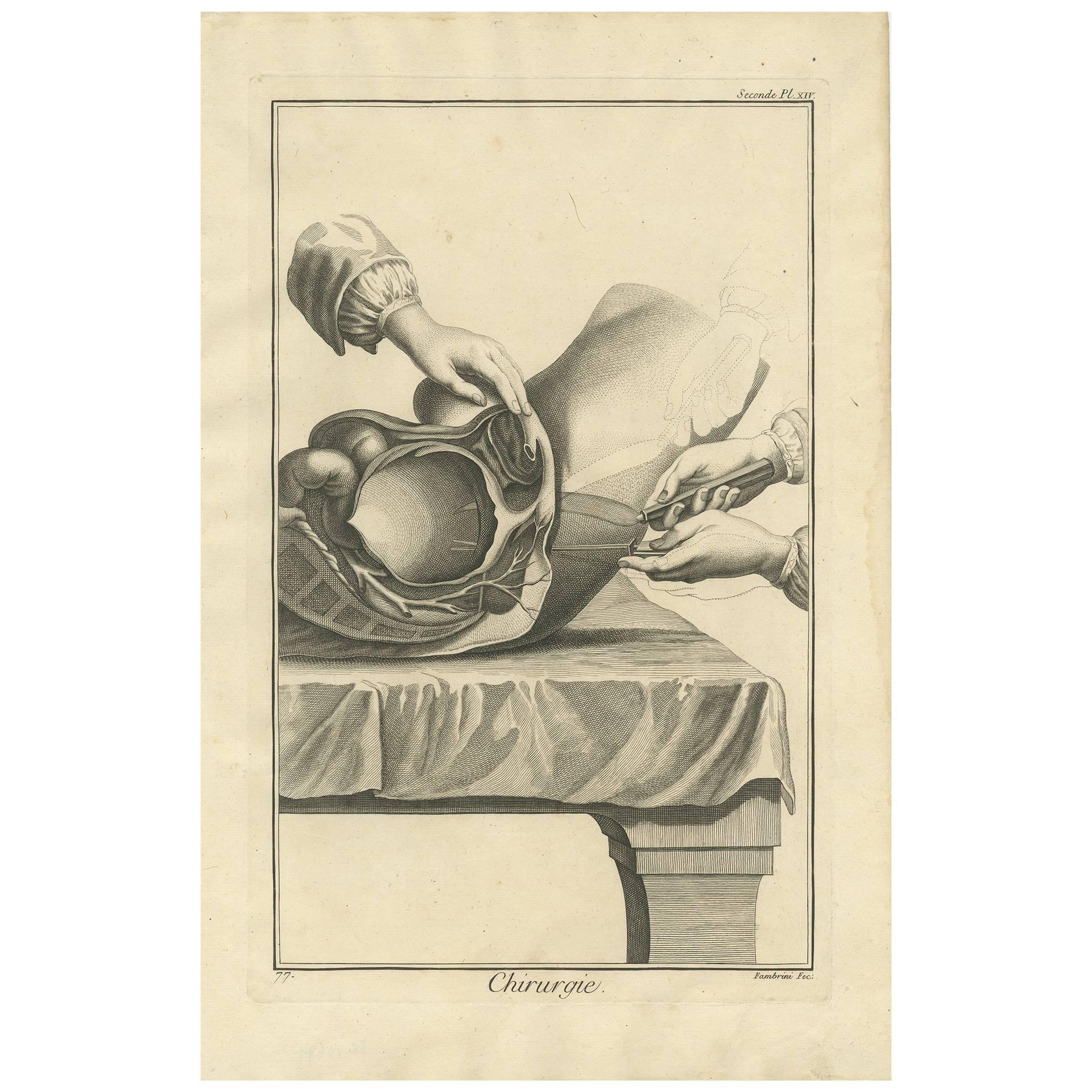 Antique Medical Print 'Seconde Pl. XIV' by D. Diderot, circa 1760 For Sale