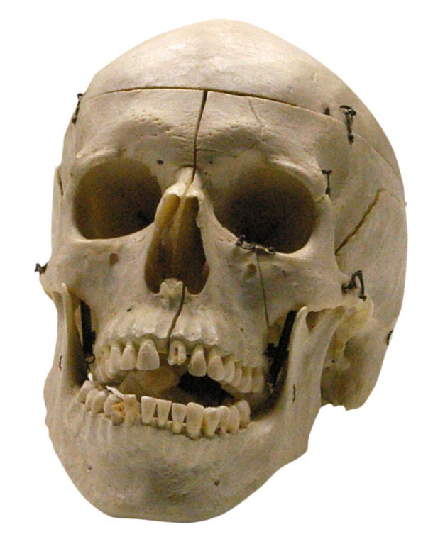 An educational human skull from a Belgian medical school. The jaw is wired together with springs and there are three small hooks around the cranium where it can be opened. A custom-fitted wood box with felt lining is included.
