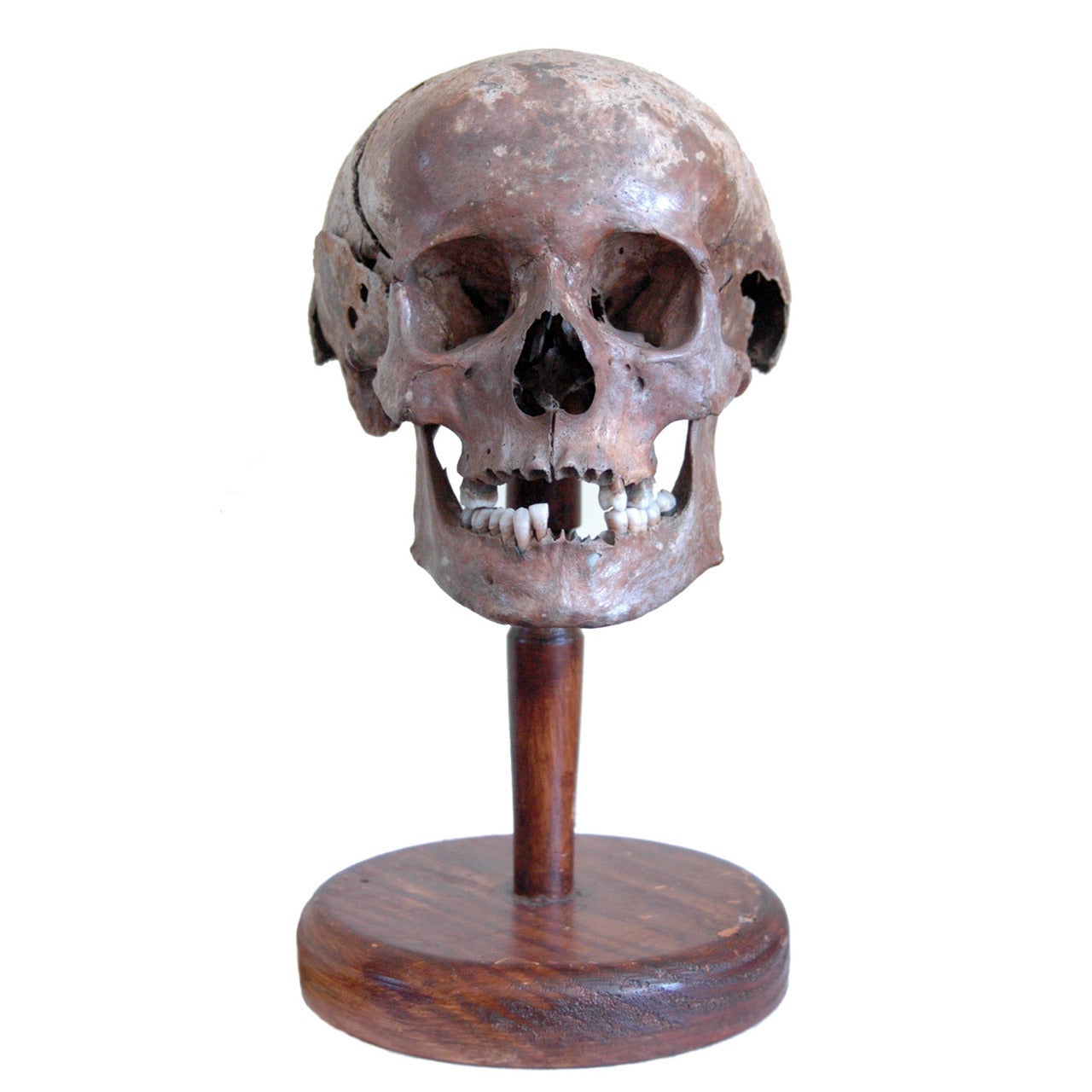 Very Early Example of a Diseased Human Skull