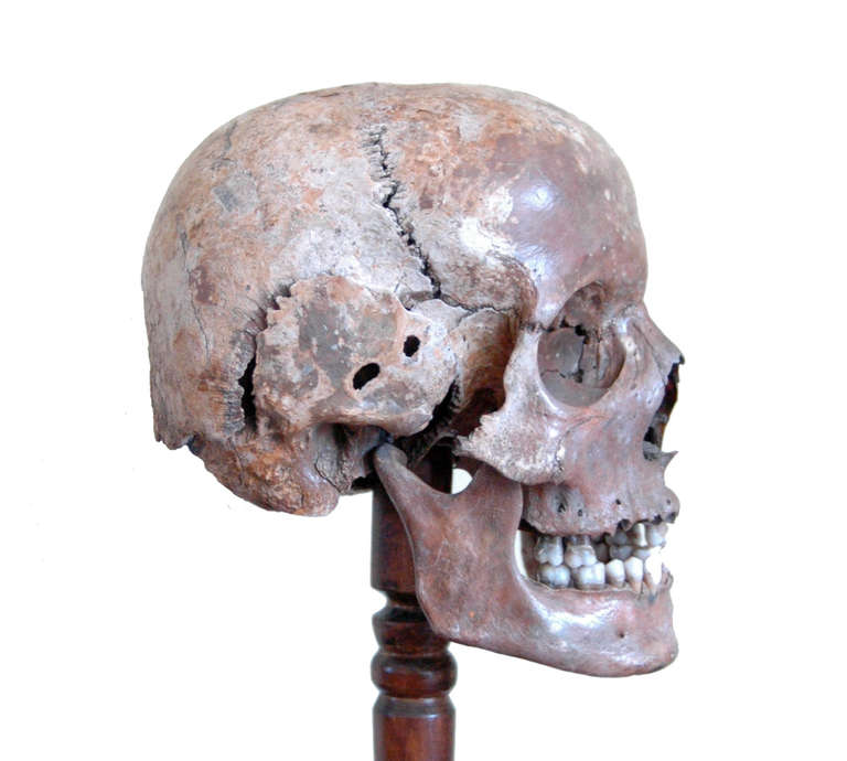 A scarce, early example of a human skull. The deformities suggest it may be have been diseased. 

This piece formed part of an extensive collection of taxidermy, medical curios and natural history specimens.

EU shipping only.