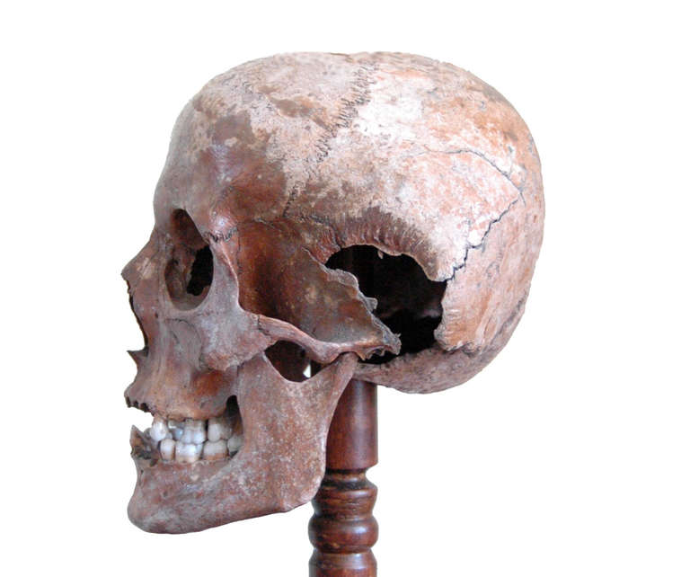 English Very Early Example of a Diseased Human Skull