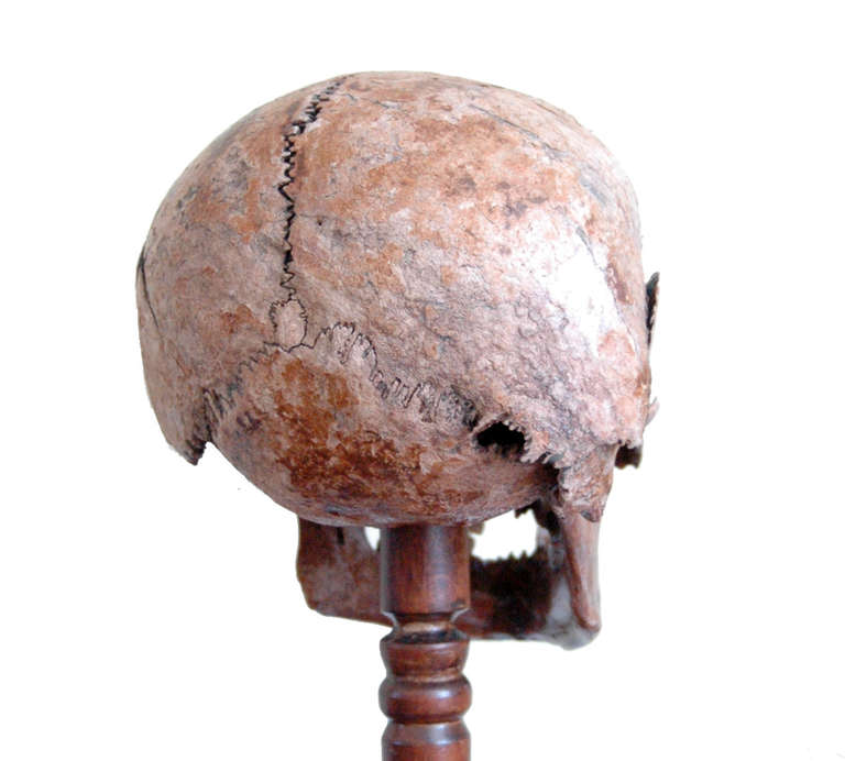 19th Century Very Early Example of a Diseased Human Skull