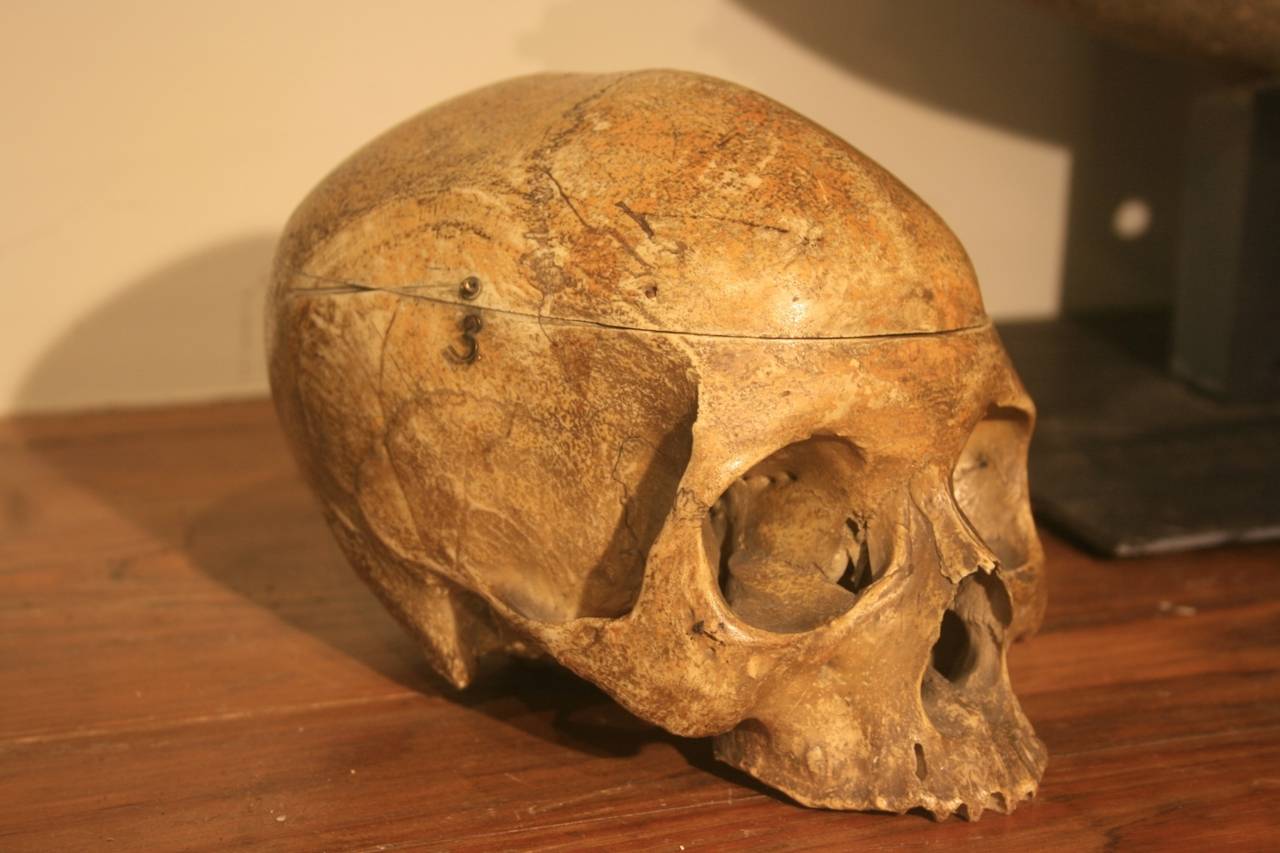 19th Century Medical School Human Skull In Excellent Condition In North Beninngton, VT