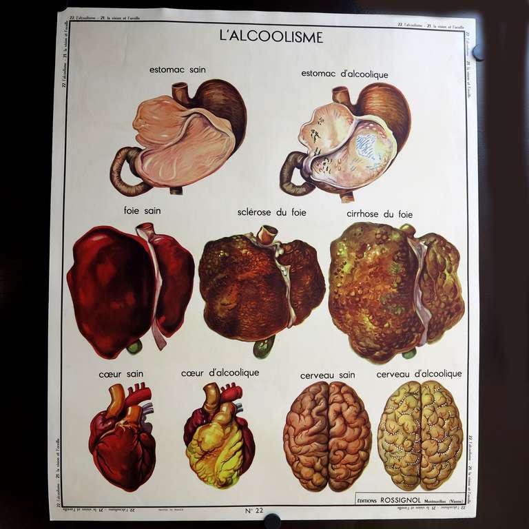Vintage human anatomy school chart, France, circa 1950 - 1955.

Title: L´ Alcolisme / La Vision.

Material: Carton, printed on both sides.

Year: 1950 - 1955.

Measure : 89 x 75 cm.

Manufacturer: Edition Rossignol.

Condition :