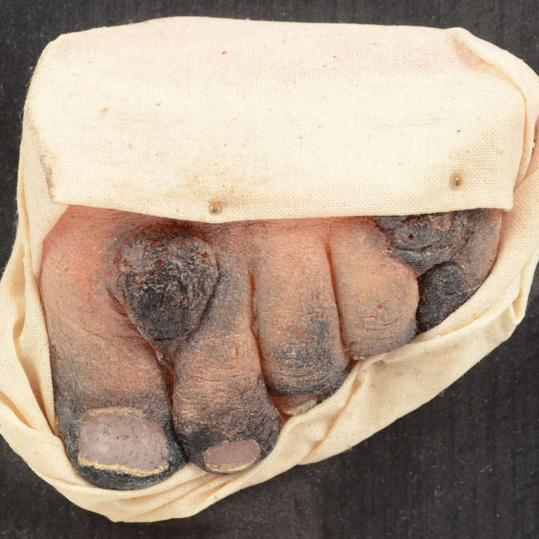 Germany 1950s Anatomical Wax Model Depicting the Aftermath of Toes Freezing In Excellent Condition In Milan, IT