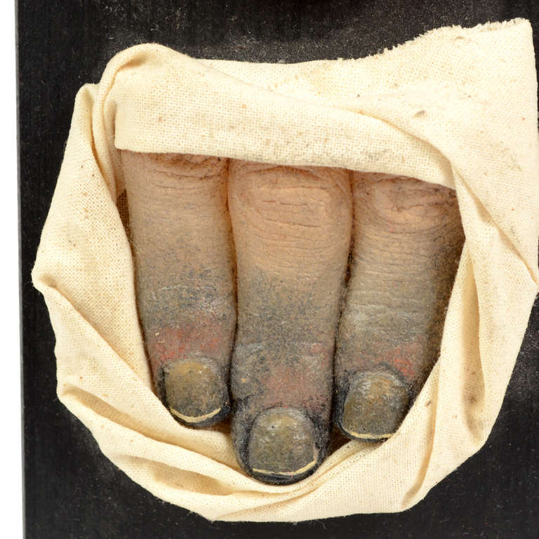 Mid-20th Century Germany 1950s Anatomical Wax Model Depicting the Aftermath of Toes Freezing
