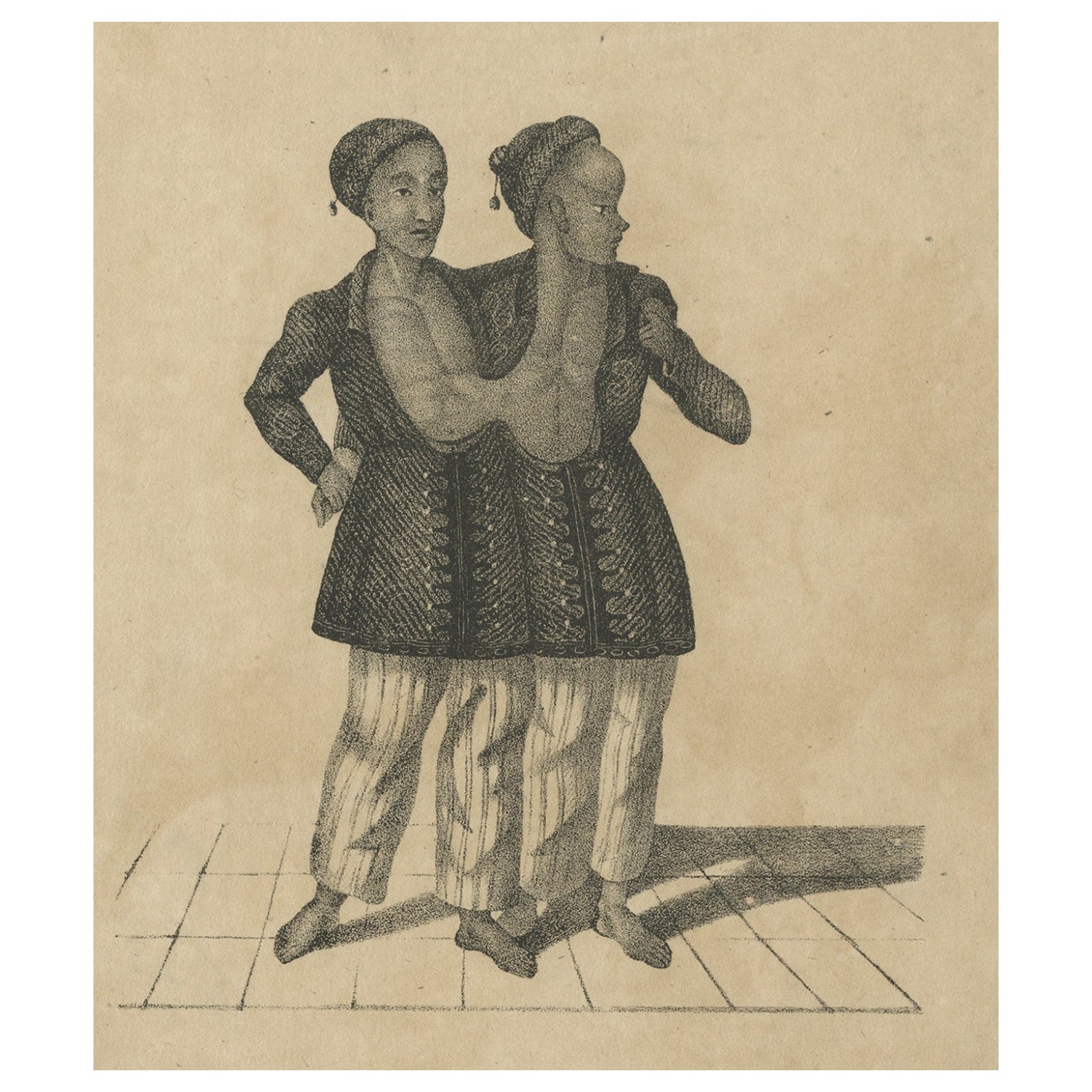 Antique Print of Conjoined or Siamese Twins, c.1860 For Sale