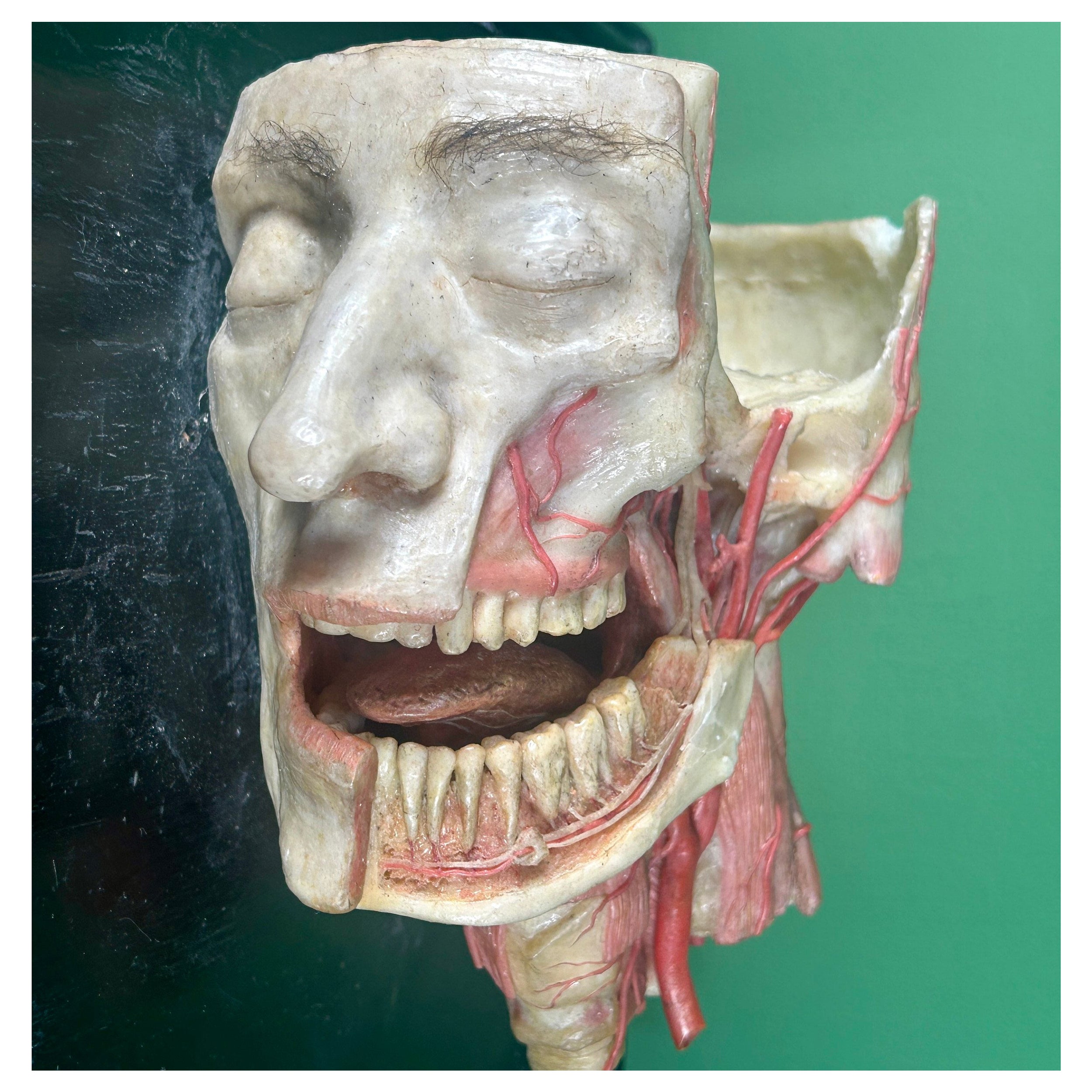 19th Century Anatomical Model of Dissected Wax Head Mounted on Framed Board