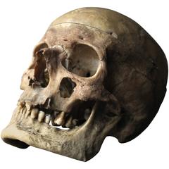 Early 20thc Human Skull for Odontology and Medical Study from Guy's Hospital
