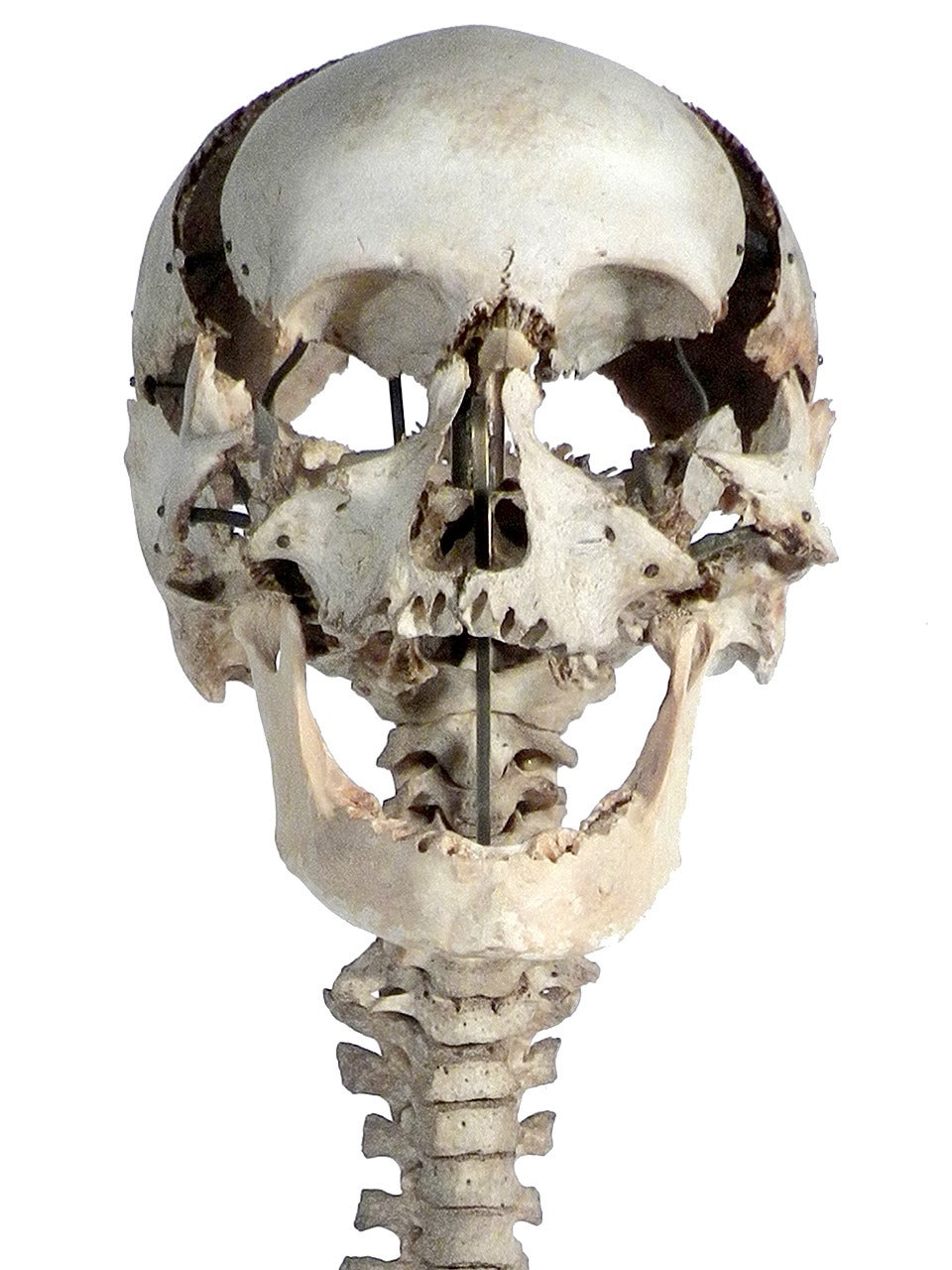 spine and skull