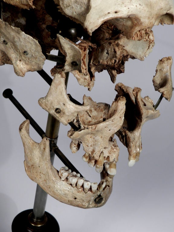 A Beauchene Skull, also known as an exploded skull, is a disarticulated human skull that has been painstakingly reassembled on a stand with jointed, movable supports that allows for the moving and studying of the skull as a whole or each piece