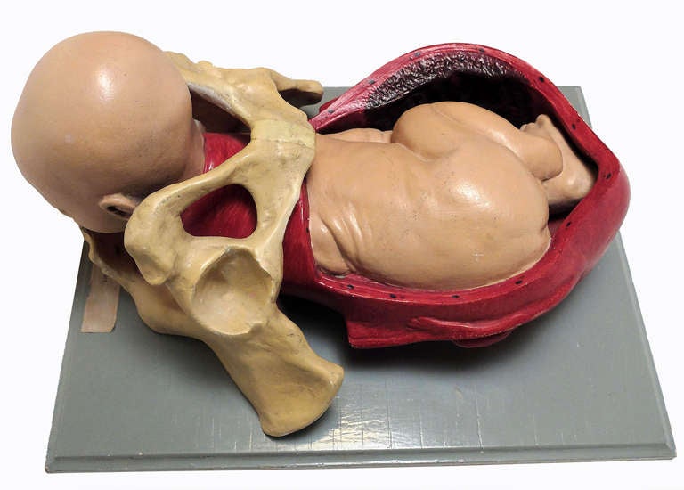 Anatomical model representing a childbirth with fetus in cephalic position. The model is made out of painted plaster and mounted over a wooden base. Dresden, Germany.