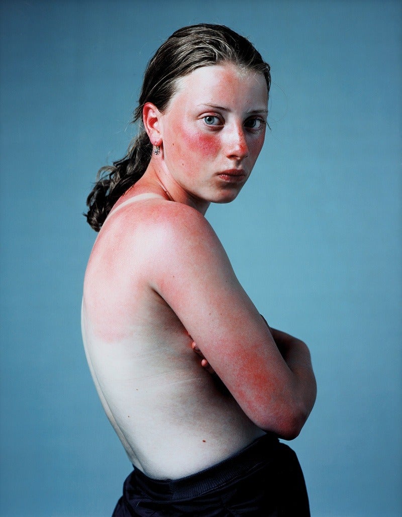 Hendrik Kerstens Portrait Photograph - Sunburn