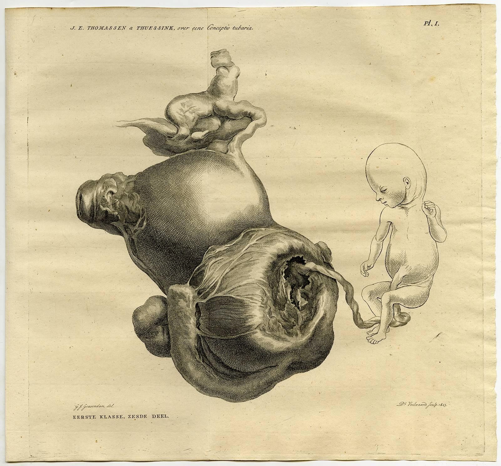 Daniel Veelwaard Junior Print - Verhandeling over eene conceptio tubaria, waargenomen in het Nosocomium [...].