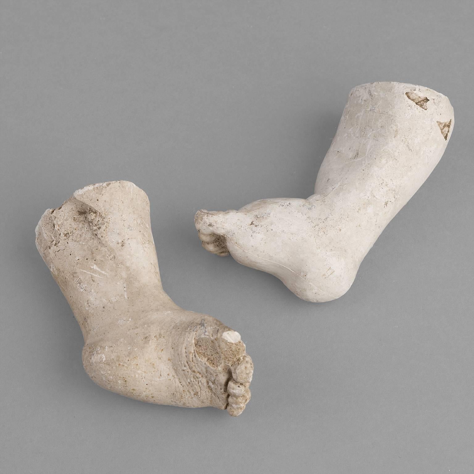20th Century Orthopedic Casts of Children, 1900-1930 For Sale