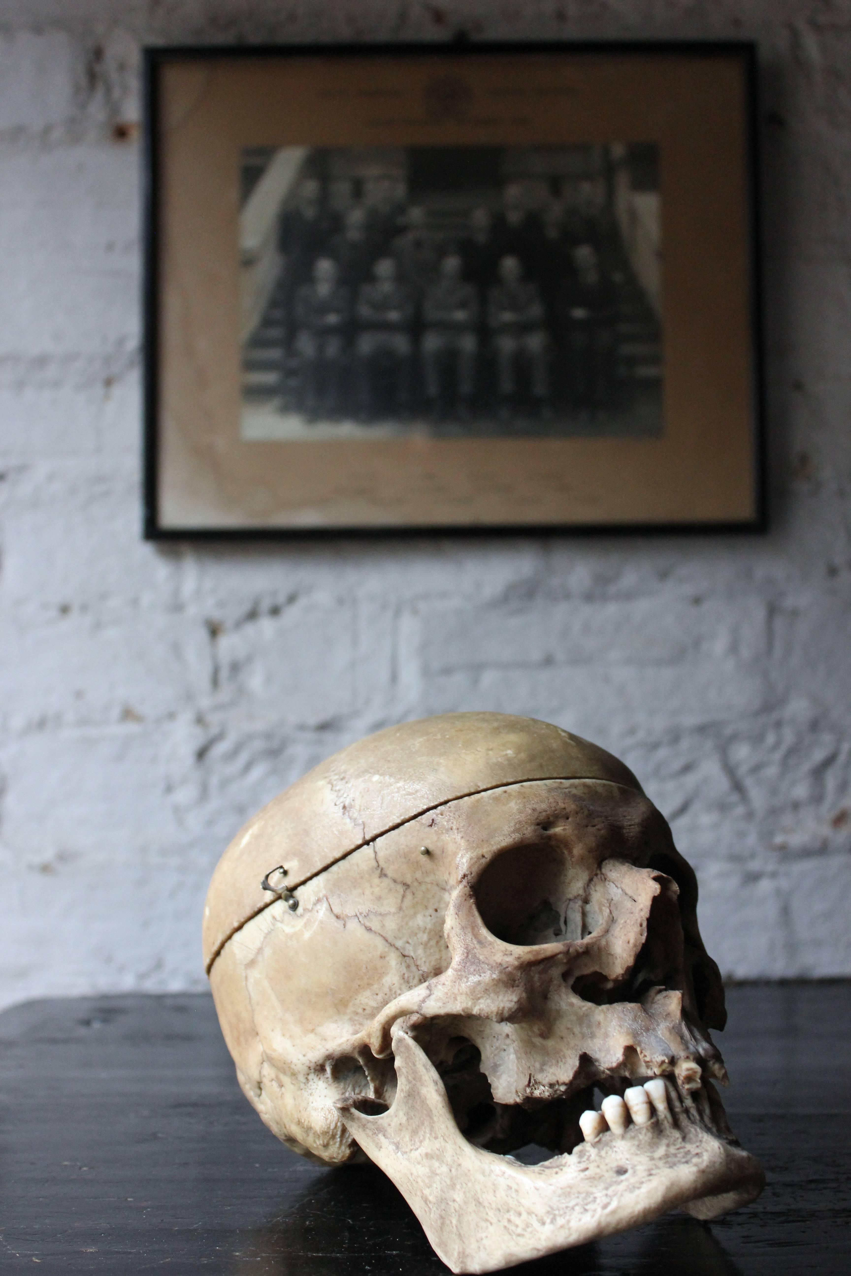 English Early 20thc Human Skull for Odontology and Medical Study from Guy's Hospital