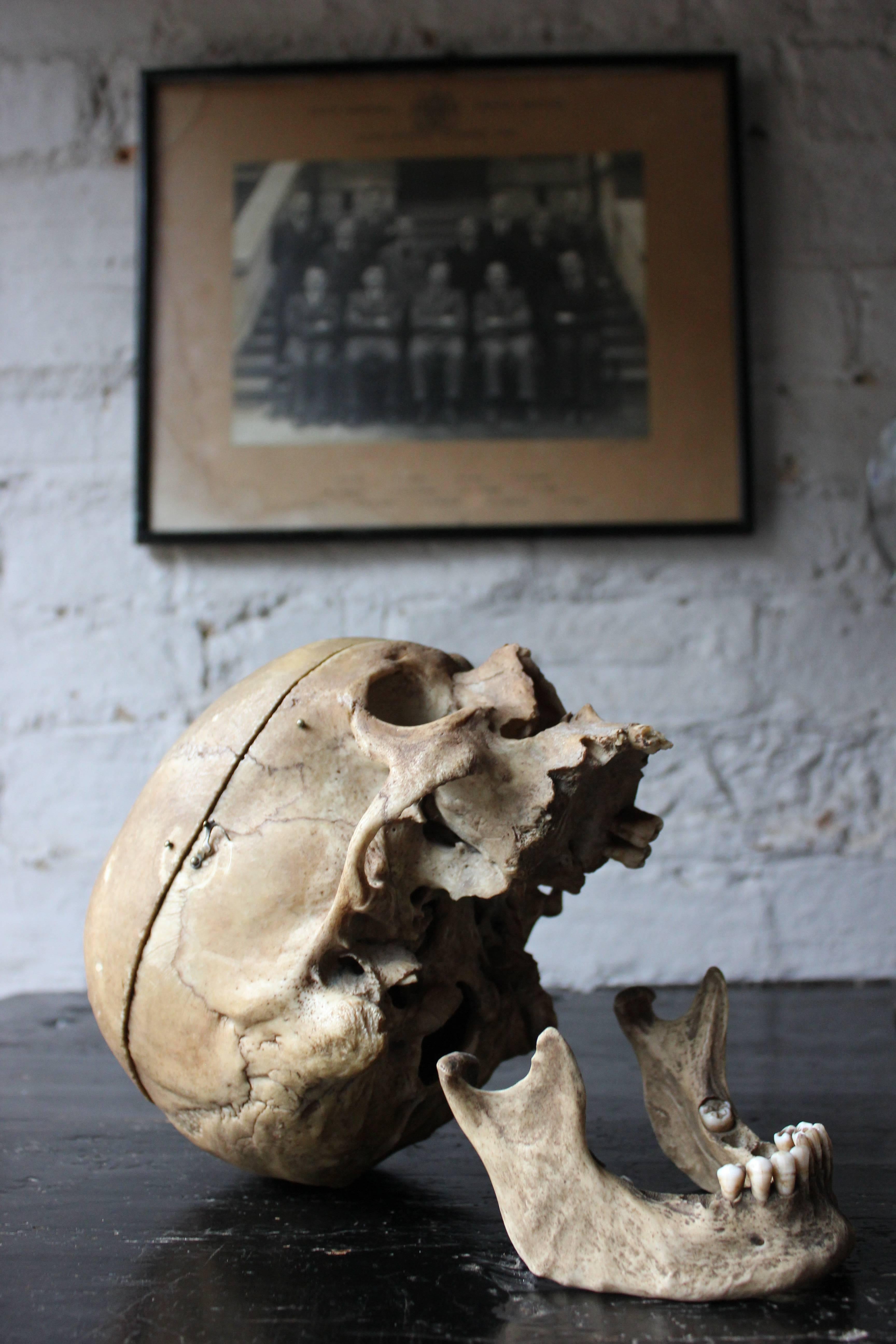 19th Century Early 20thc Human Skull for Odontology and Medical Study from Guy's Hospital