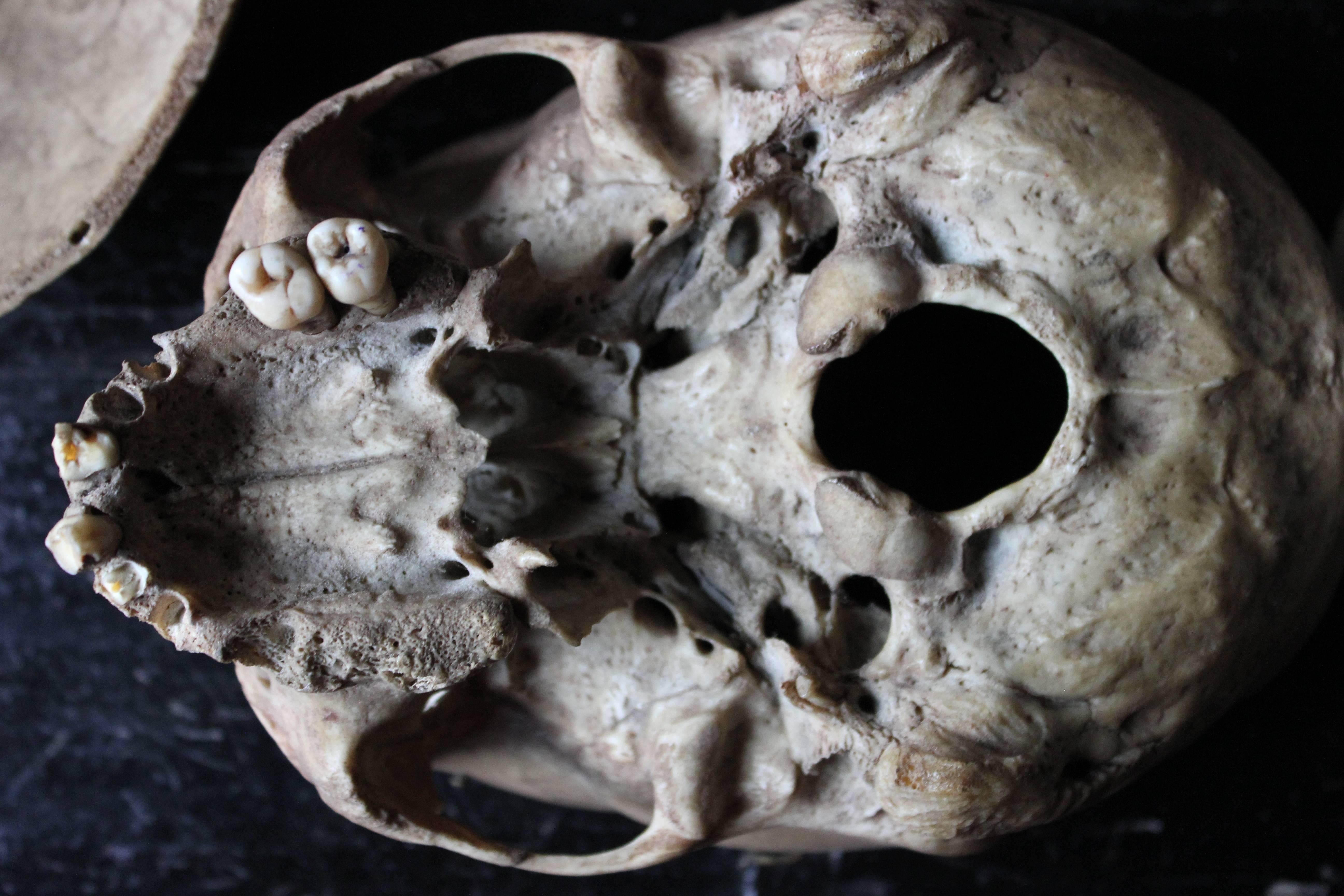 Early 20thc Human Skull for Odontology and Medical Study from Guy's Hospital In Good Condition In Bedford, Bedfordshire
