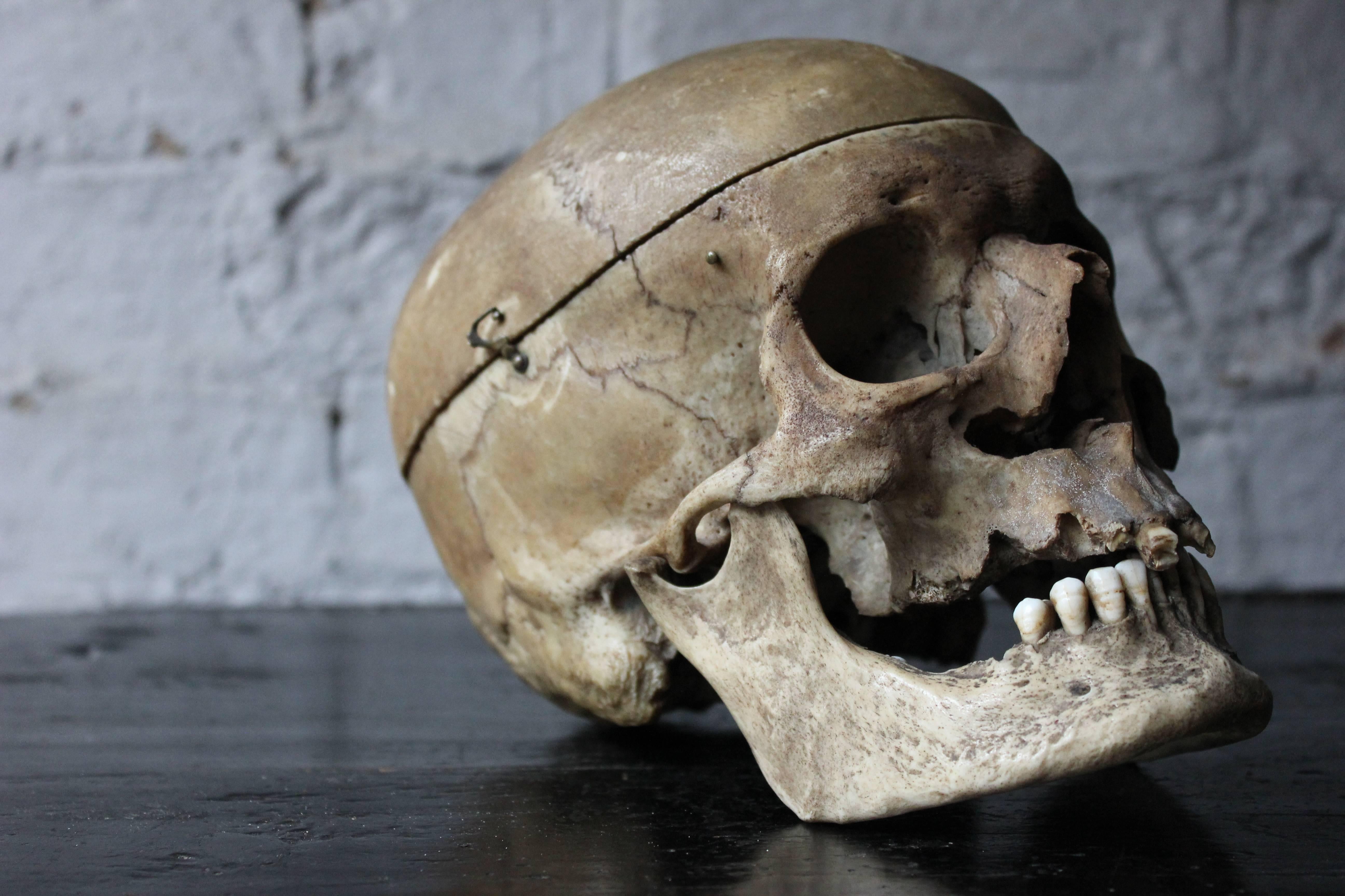 Early 20thc Human Skull for Odontology and Medical Study from Guy's Hospital 4