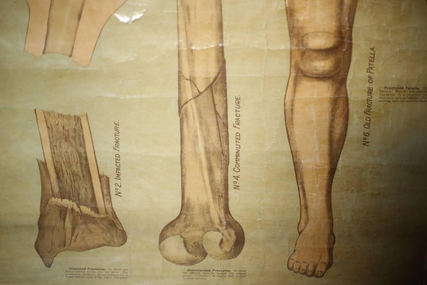 Edwardian Medical Poster of Fractures and Dislocations, Chemist Science 4
