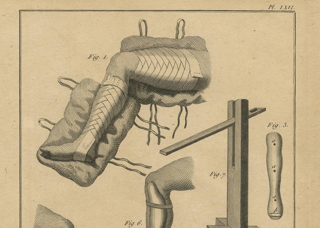 Chirurgie plate LXVI, published in 'Recueil des planches du Dictionnaire de chirurgie' by H. Agasse, circa 1798. This book contains one-hundred thirteen extraordinary engravings detailing 18th century surgery techniques, various methods of caring